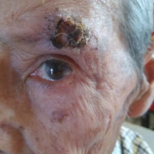 Manuel Ríos Macías | Carcinoma epidermoide de 1.5 cm